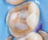 (5.) A partial coverage preparation demonstrating a simple geometry with smooth transitions. Note the presence of enamel 360 degrees around the preparation’s supragingival margin.