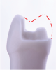 (6.) Appropriate tooth reduction is essential for a successful restoration.
