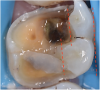 (8.) Cusps with less than 2-mm of remaining width should be included in the preparation design and capped, and those with greater width should be maintained.