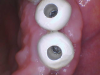 Fig 2. Intraoral camera view of custom contoured healing abutments placed to establish an ideal emergence profile.