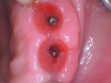 Fig 3. Occlusal view of the emergence profile and gingival architecture after adequate healing.