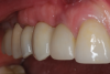 Fig 8. Close-up retracted buccal view of the final restorations in place.