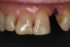 Fig 9. Preoperative maxillary retracted view of missing tooth No. 10 and failing restorations on teeth Nos. 7 through 9.