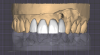 Fig 10. A digital wax-up of the anterior restorations was designed prior to treatment.