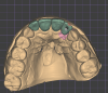 Fig 12. View of the digital design showing the optimal access location achieved with an angulated screw channel for the tooth No. 10 restoration. Note the less-than-ideal access position that would result from a straight screw channel, highlighted in red, which would be visible on the incisal edge and facial surface.