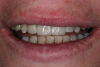 Fig 14. Postoperative smile photograph. Note the ideal amount of tooth display that was achieved and how the final restorations blend excellently with the surrounding dentition.