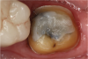 (2.) Occlusal view of a nonretentive, short clinical crown preparation for tooth No. 18 with an overtapered distal margin and short preparation wall height and occlusal and buccal views of the virtual model of the preparation following a digital scan (CEREC®, Dentsply Sirona).