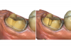 (5.) Auxiliary retentive features such as axial grooves or boxes, preferably on proximal surfaces, may be considered to enhance the geometry for retention and resistance form.