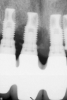 (8.) Splinted implant prosthesis.