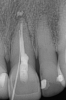 (29.) Single anterior custom abutment workflow.