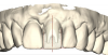 (32.) Single anterior custom abutment workflow.