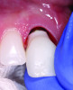 (6.) Delivery of the final screw-retained implant crown.