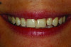 (1.) Pretreatment smile photograph of a patient with a maxillary left “peg” lateral incisor (tooth No. 10).