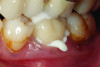 (5.) Delivery of a 3Y monolithic zirconia crown on tooth No. 19 with a resin-modified glass-ionomer cement.