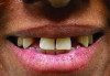 (7.) Preoperative smile photograph of a patient with congenitally missing teeth Nos. 7 and 10.