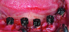 Figure 3. Intraoral view of coded cap scan bodies being used to capture the implant positions directly during the scanning phase, eliminating the need for additional scan body placement.