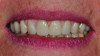 Figure 8: Wax try-in appointment