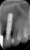 Figure 3 Identification of sufficient inter-radicular space: The radiographic representation of inter-radicular space (Fig 2) reveals abundant space for a single-tooth implant; at the alveolar crest, 
> 6 mm of interproximal space is available for placeme