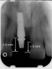 Figure 4 Characterization of the interproximal bone and tooth contacts: A periapical radiograph assists in measuring the distance from bone crest to the adjacent tooth contact points for missing tooth No. 8. The mesial bone crest to the adjacent tooth con