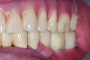 Fig 9. Class I occlusal relationship. Anterior and posterior teeth in contact. Patient originally had a Class II relationship.