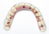 Fig 10. Ten-year follow-up. Worn denture teeth and multiple repairs.