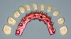Fig 15. Pink anodized milled titanium frame with CAD/CAM-milled e.max crowns that can be replaced by a digital copy if necessary.