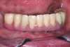 Fig 18. Final restoration in place that can be easily and predictably removed and serviced. The e.max crowns will wear like enamel and do not need to be replaced like denture teeth.