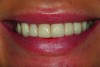 Fig 1. A preoperative smile view of a 26-year-old patient whose chief complaint is that her “teeth look too big and look like dentures.”