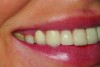 Fig 3. This oblique view of the preoperative smile shows the extreme size difference between the large maxillary anterior teeth and the smaller, diminutive posterior teeth—the “posterior gummy smile.”