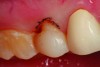 Fig 4. After apical repositioning of the gingival margin over tooth No. 4 with a diode laser, the overcontouring of the porcelain to accommodate the preoperative gingival position is evident. The excessive emergence profile on the disto-proximal aspect of the veneer restoration has caused a chronic marginal periodontitis in the area so that bleeding is always present regardless of the level of home care.