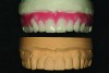 Fig 10. The maxillary diagnostic wax-up and stone model duplicate is shown. These will serve as a template for the provisional restoration.