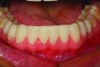 Fig 14. A retracted facial view of the “provisional preparation guide” in rubberized urethane over the unprepared mandibular teeth.