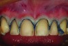 Fig 17. A retracted view of the maxillary preparations after retraction cord placement. The final margin placement will be slightly intracrevicular to avoid root surface being visible, because the patient can show gingival tissue with an exaggerated smile.