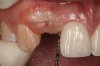 Figure 10 Clinical examination of the bound edentulous space: Measurement of the distal (Fig 10) and mesial (Fig 11) interproximal tissue height using a periodontal probe supplements data obtained from the periapical radiograph. Estimation of the buccal t