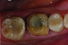 Figure 2: Crown preparation of tooth No. 30.