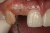 Figure 11 Clinical examination of the bound edentulous space: Measurement of the distal (Fig 10) and mesial (Fig 11) interproximal tissue height using a periodontal probe supplements data obtained from the periapical radiograph. Estimation of the buccal t