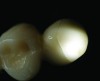 Fig 2. An example of an incomplete fracture of the veneering porcelain to the zirconia substructure.