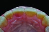 Fig 1. Lingual view of maxillary right central incisor with associated pink lesion.