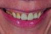Fig 4. The patient demonstrates a high smile line, leading to a much higher esthetic risk factor during treatment planning for implant therapy.
