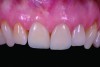 Fig 9. Three-year recall of ATLANTIS Crown Abutment, demonstrating excellent soft-tissue stability and health.