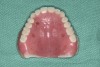 Fig 8. Maxillary denture with fiduciary markers.