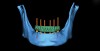 Fig 11. Virtual mandibular treatment plan with 6 planned implants.