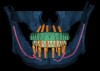 Fig 12. Complete virtual treatment plan of both arches.