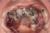 Fig 13. Maxillary surgical guide with pin fixation.