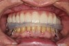 Fig 14. Maxillary prosthesis luted to temporary copings.