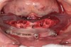 Fig 17. Mandibular bone foundation guide with pin fixation.