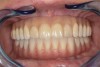 Fig 23. Final maxillary and mandibular prostheses in place.