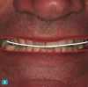 Fig 2. Digital evaluation will be used to determine the tooth position based on patient’s facial features.