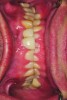 Fig 4. Retracted view shows amount of wear, bone loss, and interocclusal space.