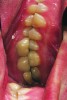 Fig 7 Left and right quadrants showing interocclusal space. Interocclusal space can be a reference for loss of vertical or can be a case of passive eruption.